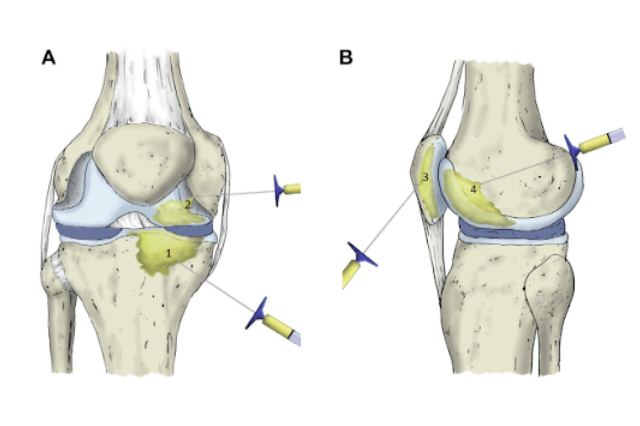 Terapia biológica intraósea en el tratamiento de artrosis de rodilla severa