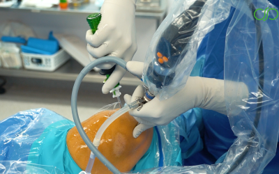 Beneficios de la sutura meniscal y cuándo se recomienda