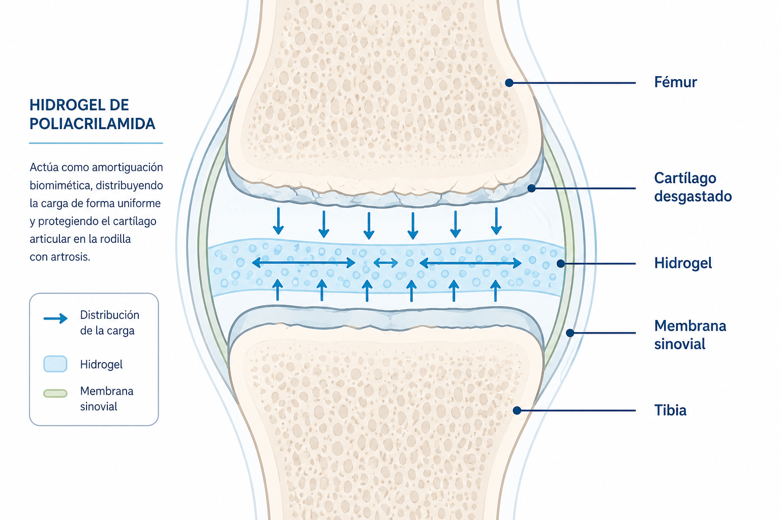 Esquema del mecanismo del hidrogel para tratamiento de rodilla con artrosis
